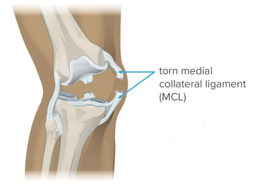 How to Diagnose a Medial Collateral Ligament Injury